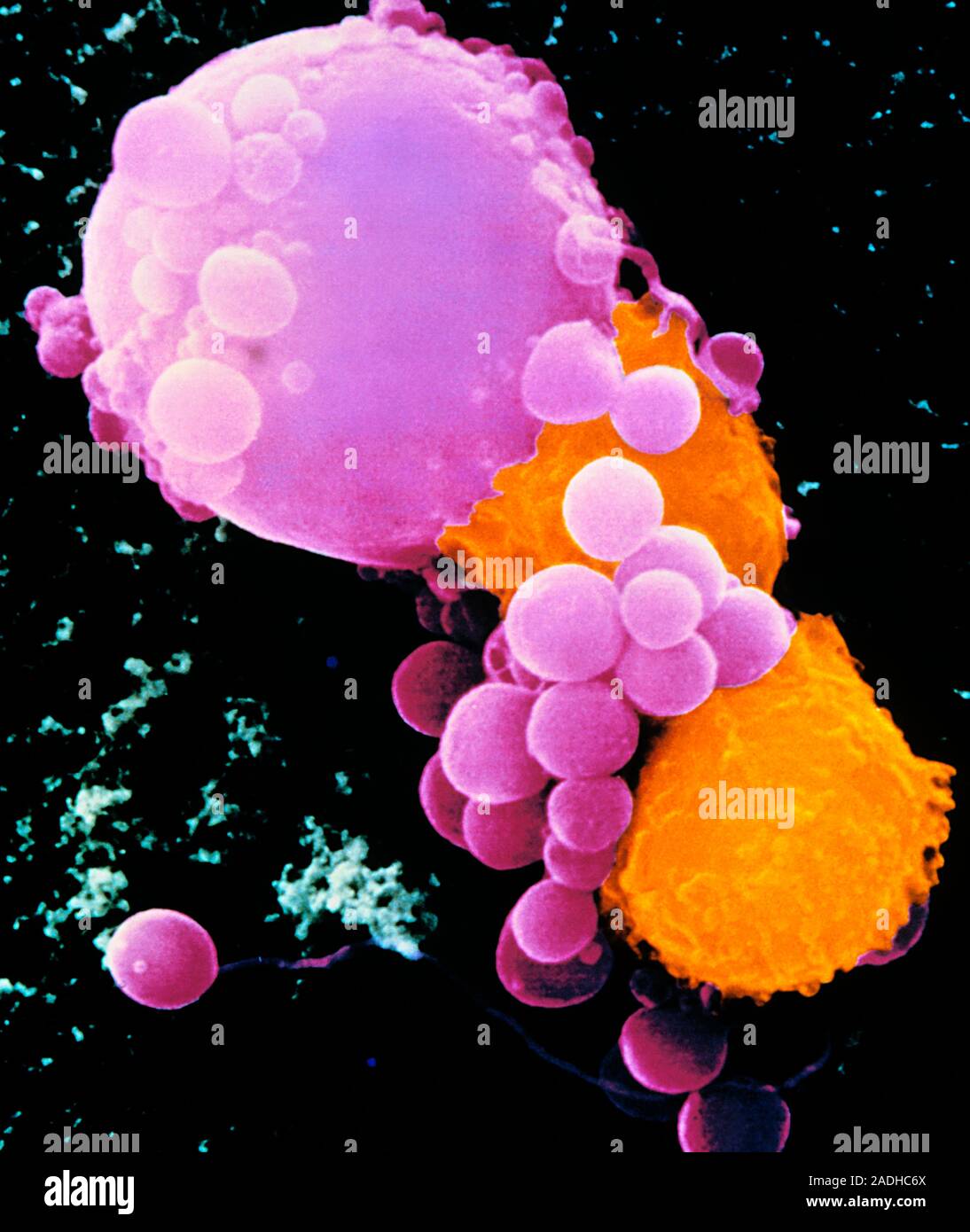 La muerte de las células cancerosas. Color análisis micrografía de electrones (SEM) muestra La muerte de las células cancerosas. Color análisis micrografía de electrones (SEM) muestra