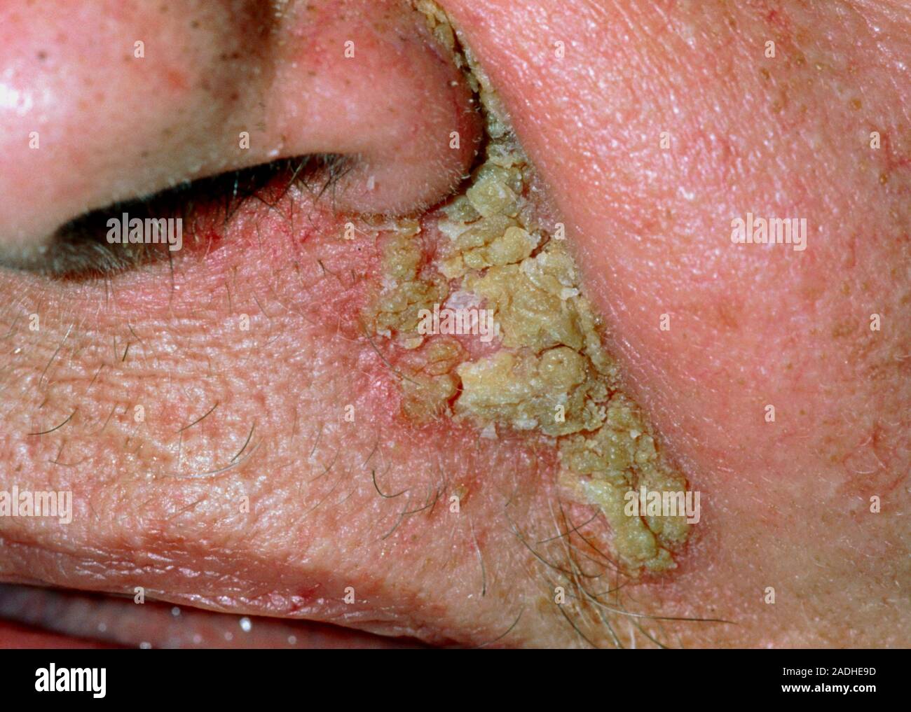 Dermatitis seborreica. Close-up de una erupción de dermatitis seborreica por de la nariz paciente. Una costra amarilla se ha formado sobre el depósito, inflamar Fotografía de stock - Alamy