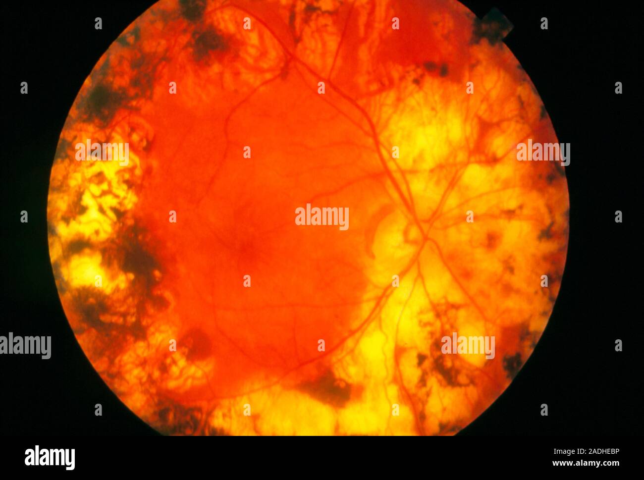 Tratar la retinopatía diabética. Oftalmoscopio vista de la retina del ojo  de un paciente diabético que sufren retinopatía, después del tratamiento  con láser. Norma Fotografía de stock - Alamy