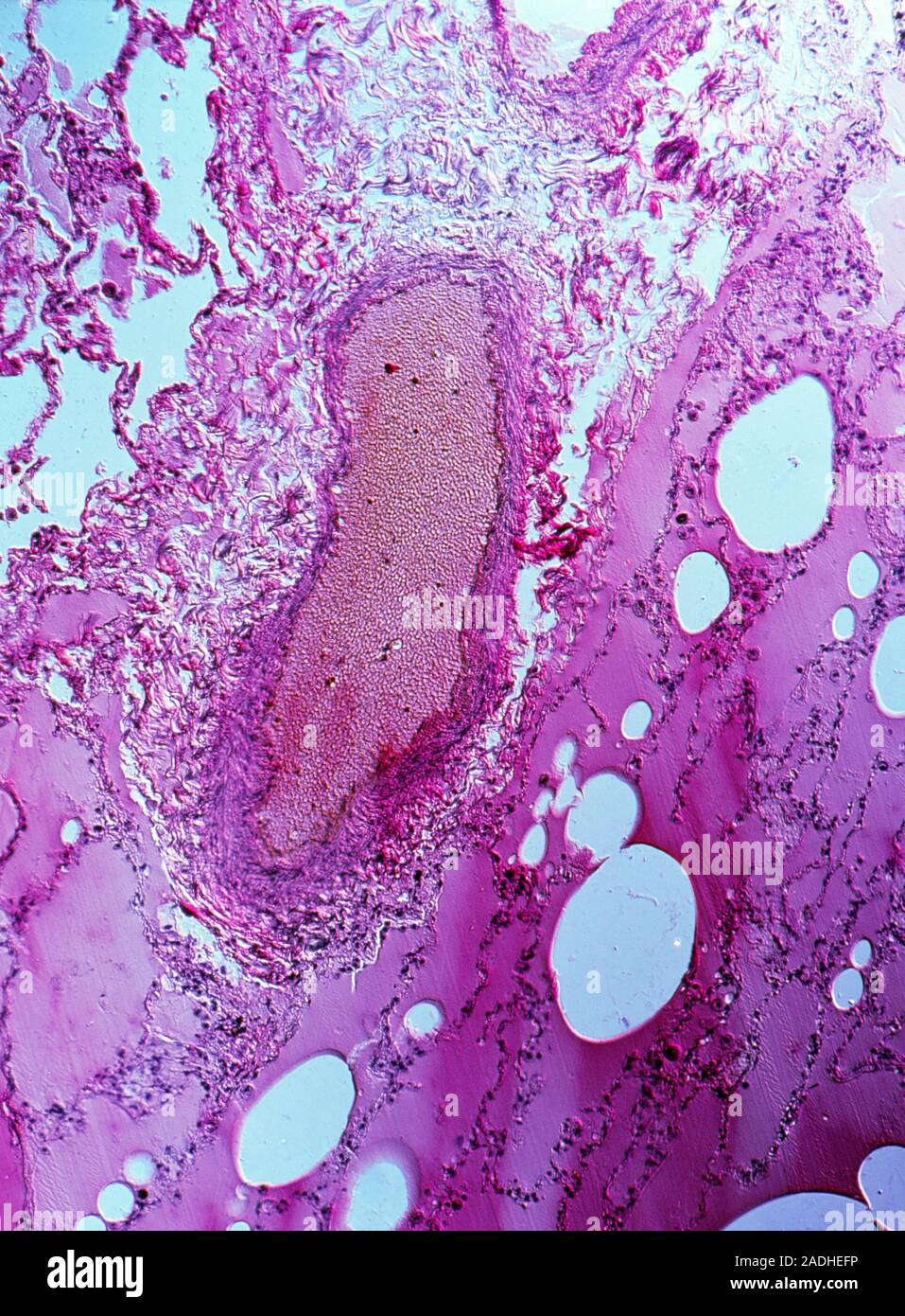 Micrografía De Luz Que Muestra La Apariencia Del Tejido Alveolar