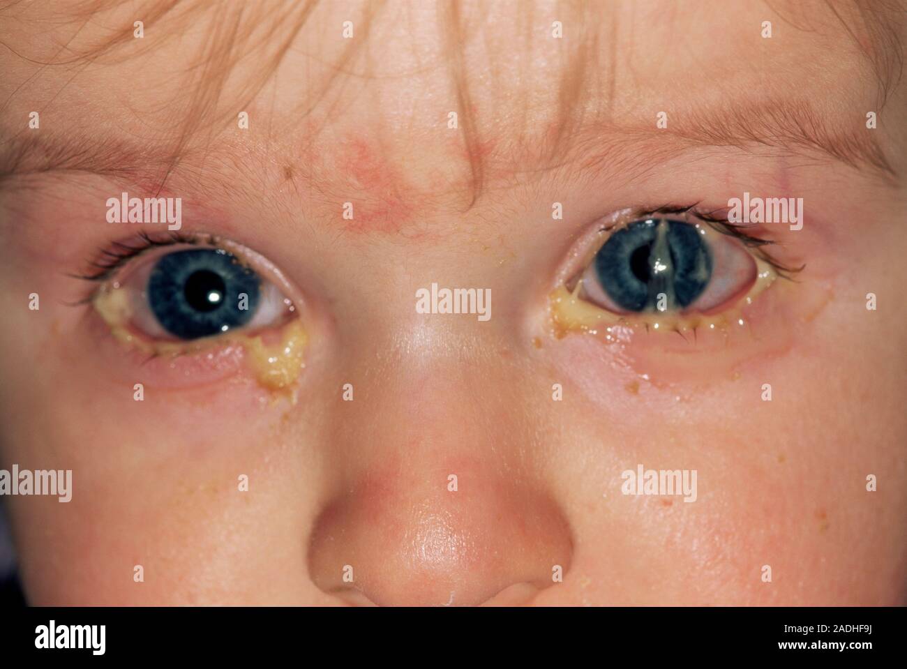 La conjuntivitis bacteriana. Un año de edad con pus alrededor de su rojo, ojos  hinchados. Estos síntomas son característicos de la conjuntivitis  bacteriana, la i Fotografía de stock - Alamy