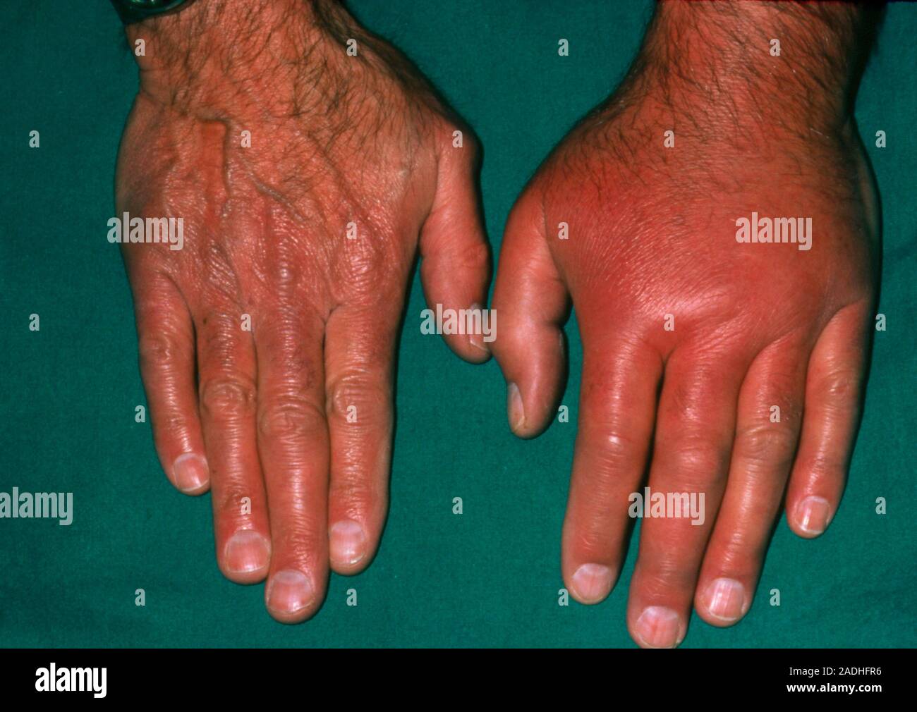 La gota. La mano izquierda de un paciente afectado por la gota. La gota es  una enfermedad articular común que es causada por la deposición de  cristales de ácido úrico en el