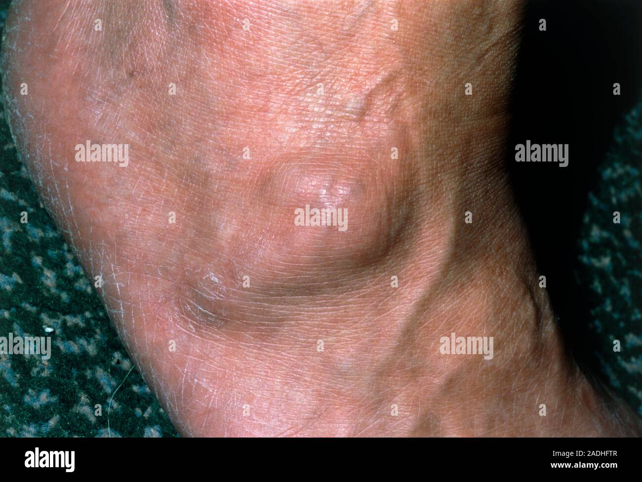 Ganglión. Vista de' un ganglio quístico (centro) en el pie de una