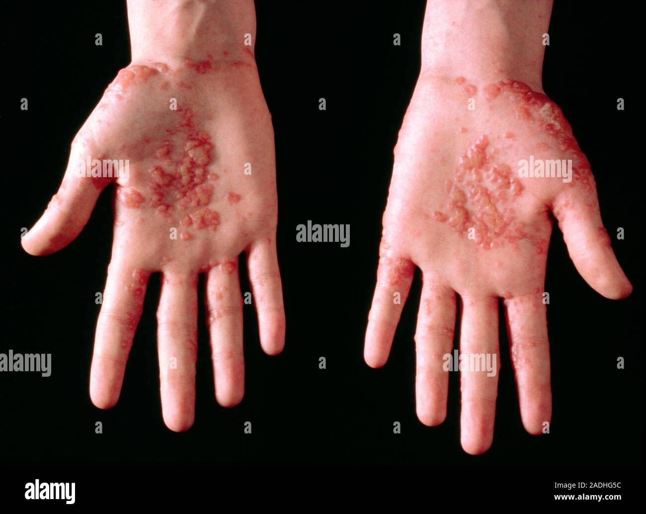 Herpes simplex cutáneo: verruga-como ampollas en una mano. El virus del  herpes simplex son algunos de los virus humanos más comunes parásitos.  Existen dos tipos de di Fotografía de stock - Alamy