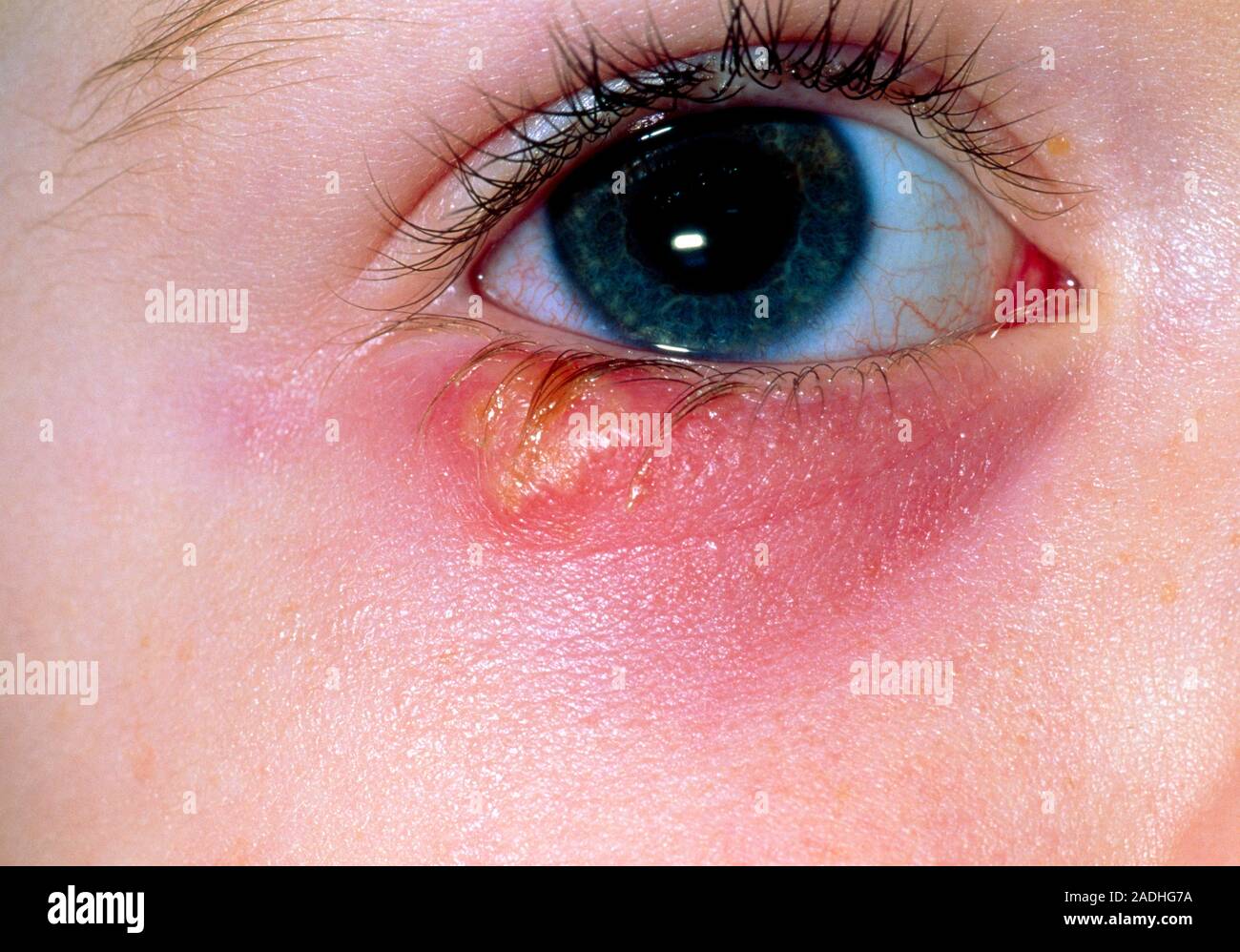 El Herpes simplex. Primer plano del ojo de 2 años de edad mostrando una  ampolla por herpes simplex en su párpado inferior. La pequeña ampolla llena  de líquido Fotografía de stock - Alamy