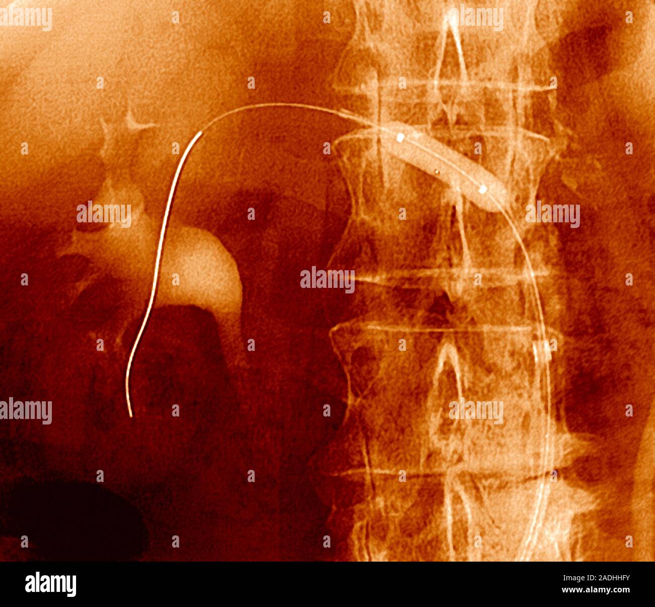 Angioplastia renal. Color angiografía de rayos X se colocan un catéter