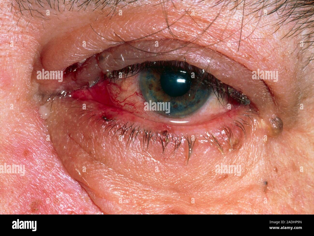 Herpes zóster del ojo. Cerca del ojo de una mujer de 60 años de edad  afectados por el herpes zoster. El herpes zoster o culebrilla es causado  por el virus varicela-zo Fotografía