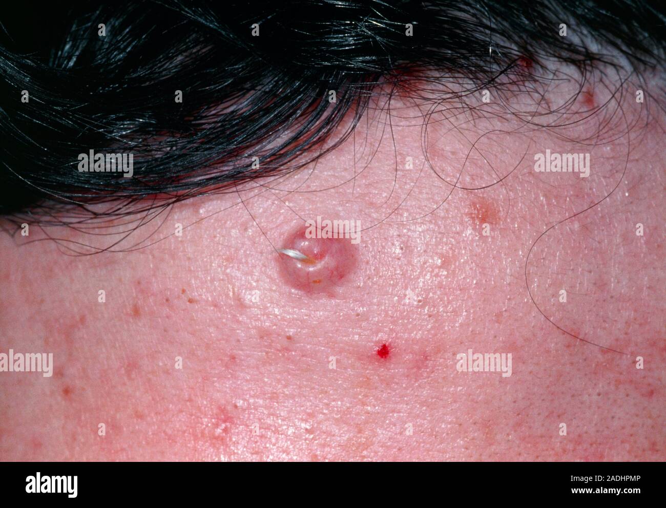Tricoepitelioma. Closeup de un tricoepitelioma sobre la piel del