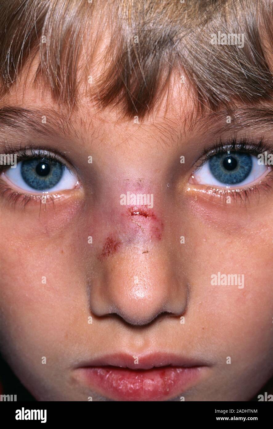 La nariz rota de un niño de 7 años de edad Fotografía de stock - Alamy