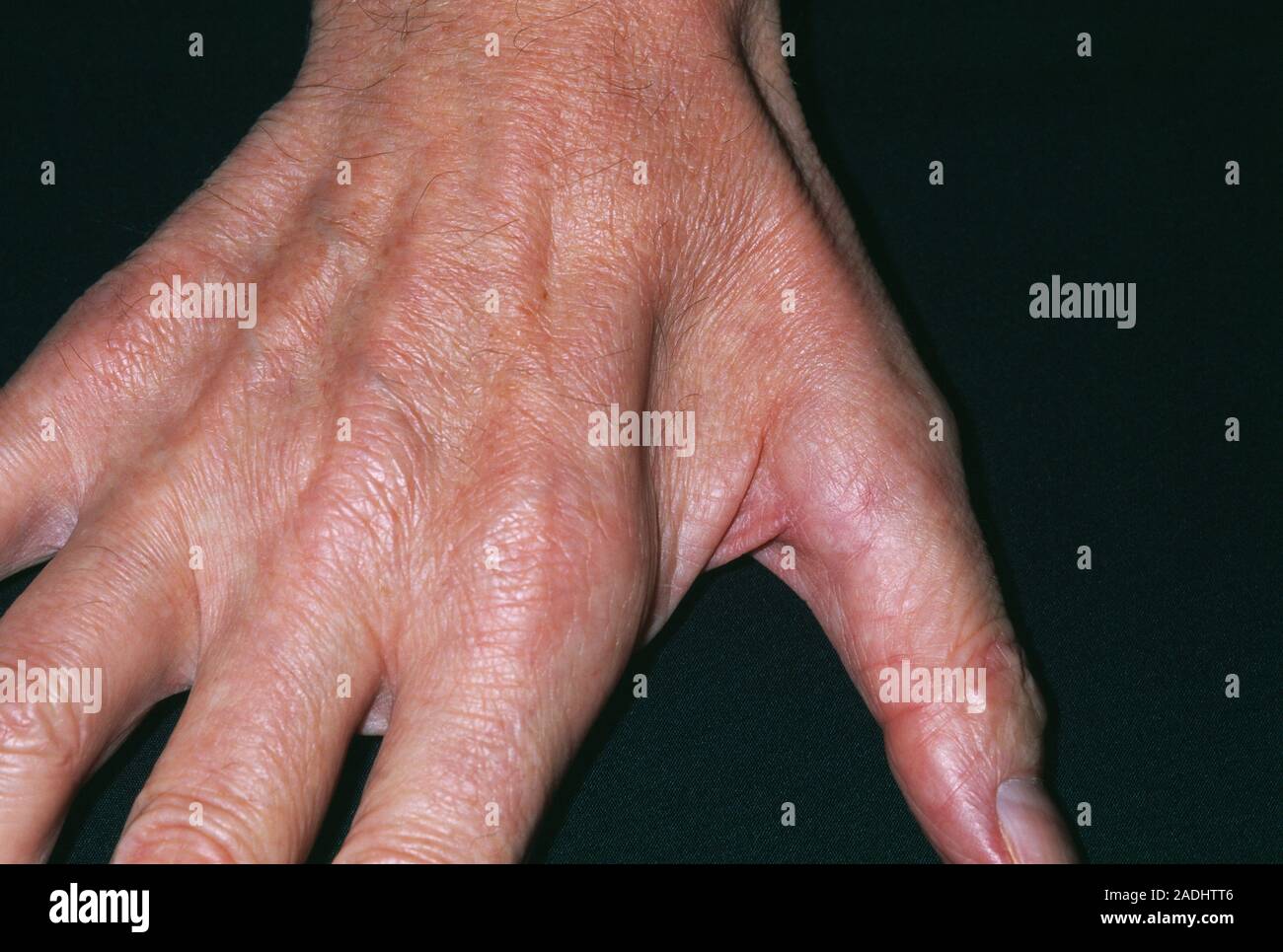 el desgaste muscular mano de un 71 año viejo hombre mostrando la