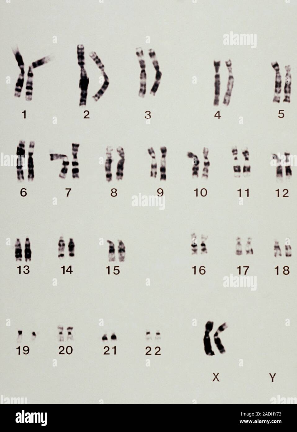 Cariotipo que muestra la disposición de los cromosomas de una mujer con el  síndrome del maullido del gato, un clásico trastorno cromosómico que  implica una eliminación de c Fotografía de stock -