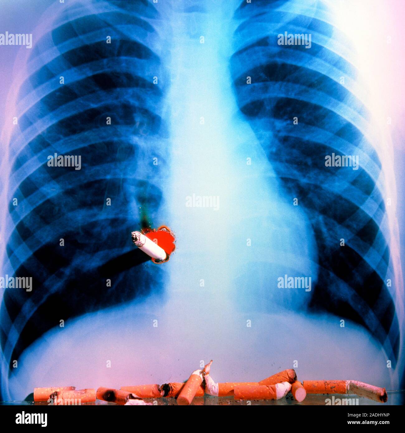 Tabaquismo y enfermedades pulmonares. Rayos X de un par de pulmones sanos,  perforado por un cigarrillo ardiendo. Las colillas de cigarrillos son en el  fondo. Fumar Fotografía de stock - Alamy