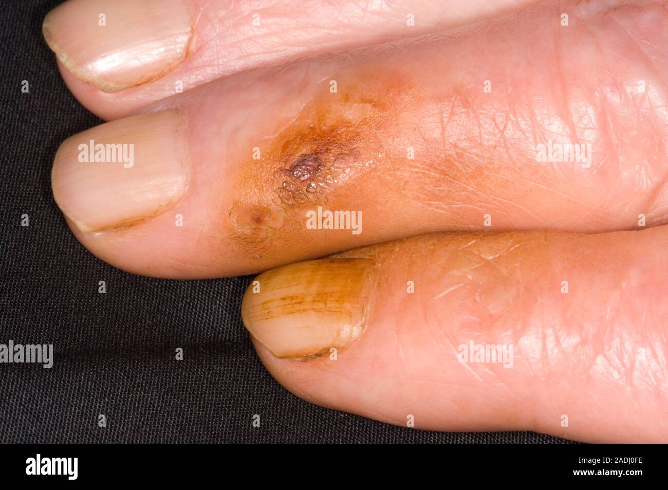 Los dedos del fumador. Mancha marrón en los dedos y uñas de un fumador de  cigarrillos. Esto es debido a la mancha de alquitrán y nicotina que se  encuentra en el tabaco