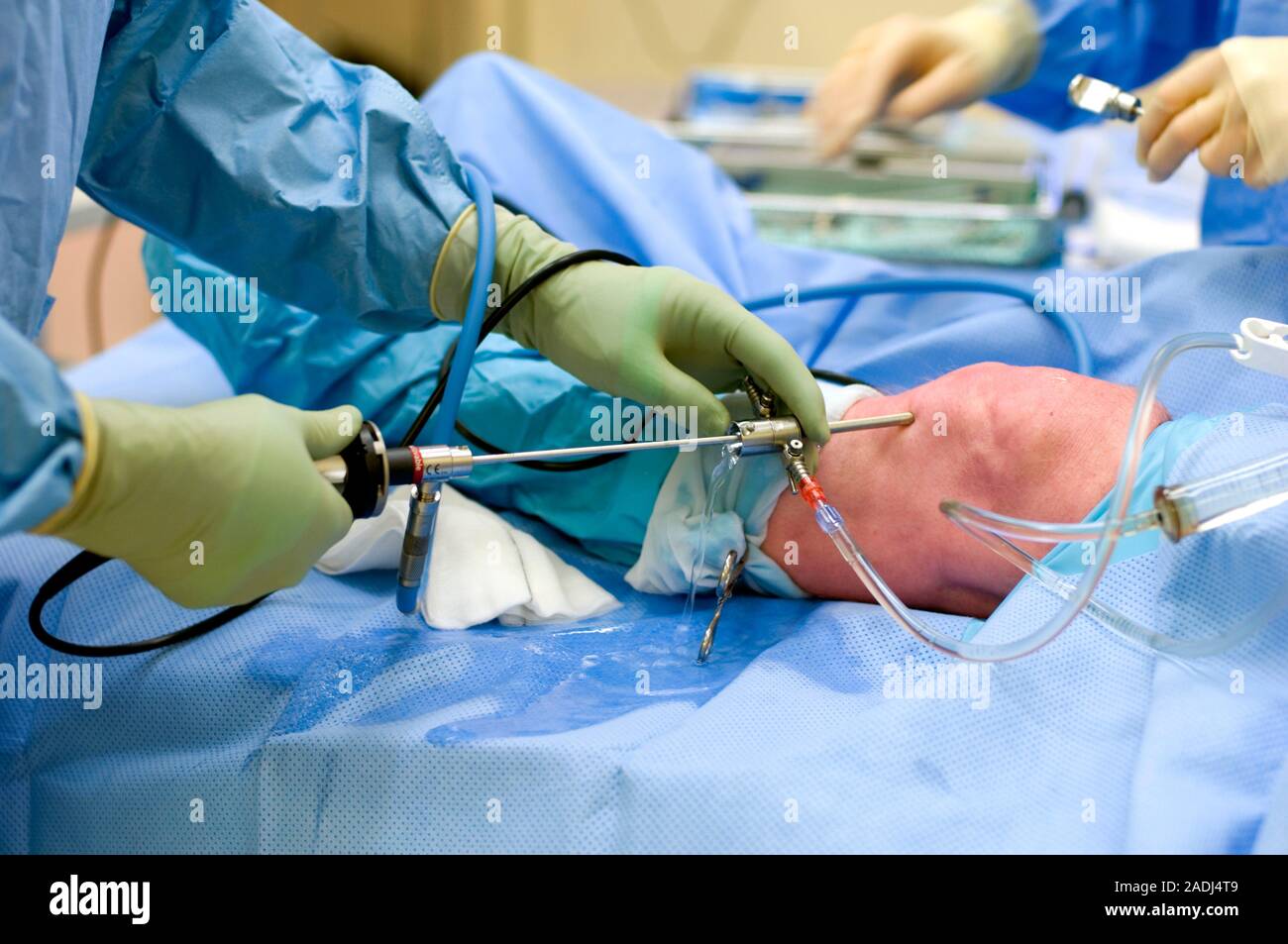 Artroscopia de la rodilla. Imagen 2 de 2. El cirujano inserta un  artroscopio a través de un intrument en una rodilla del paciente. El  artroscopio (estrecho Telescope) es Fotografía de stock - Alamy