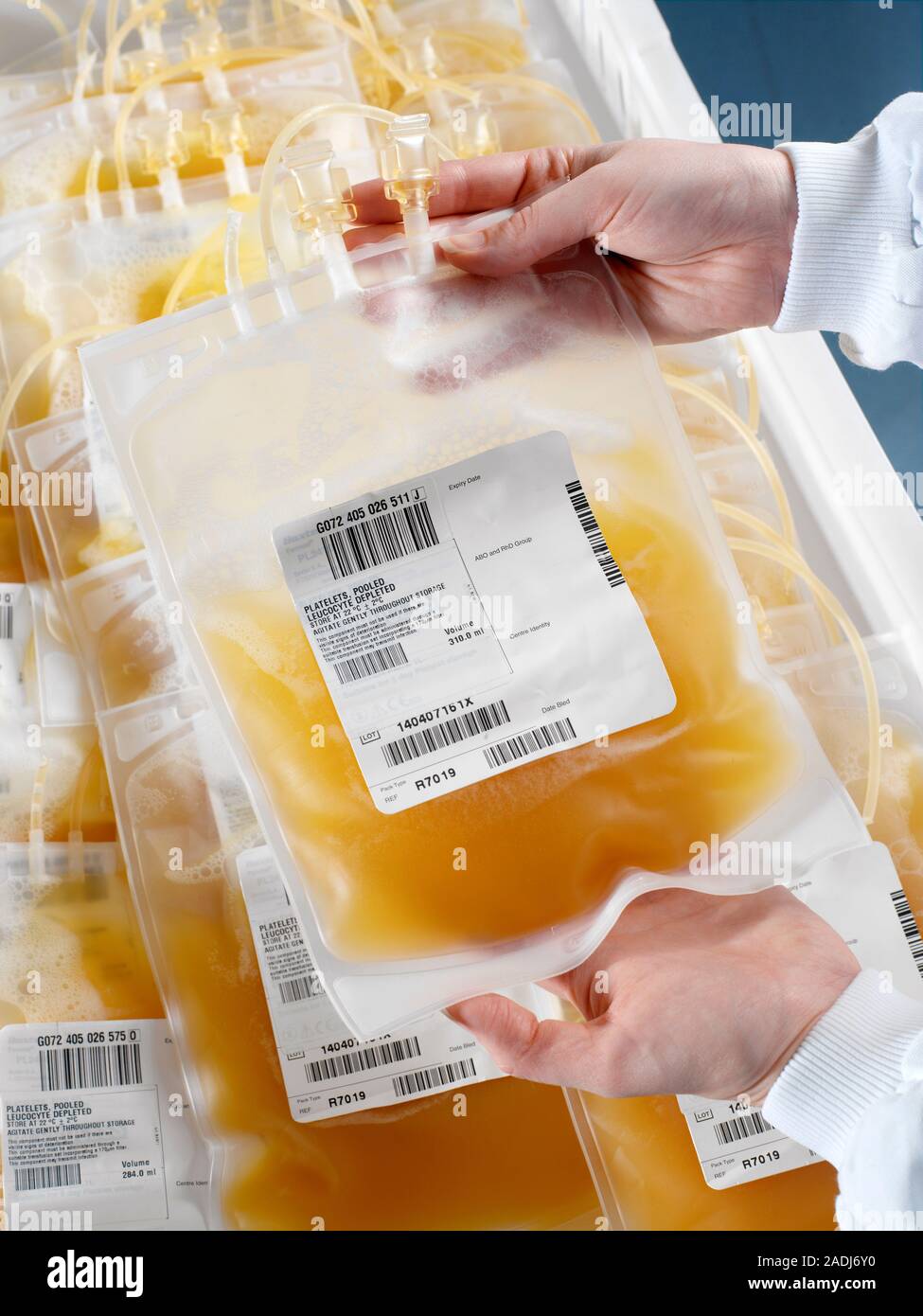 Combinaron las plaquetas de la sangre. Investigador sosteniendo una bolsa  que contiene la sangre de donantes agrupados plaquetas o trombocitos,  suspendidos en el plasma sanguíneo (el líquido compo Fotografía de stock -