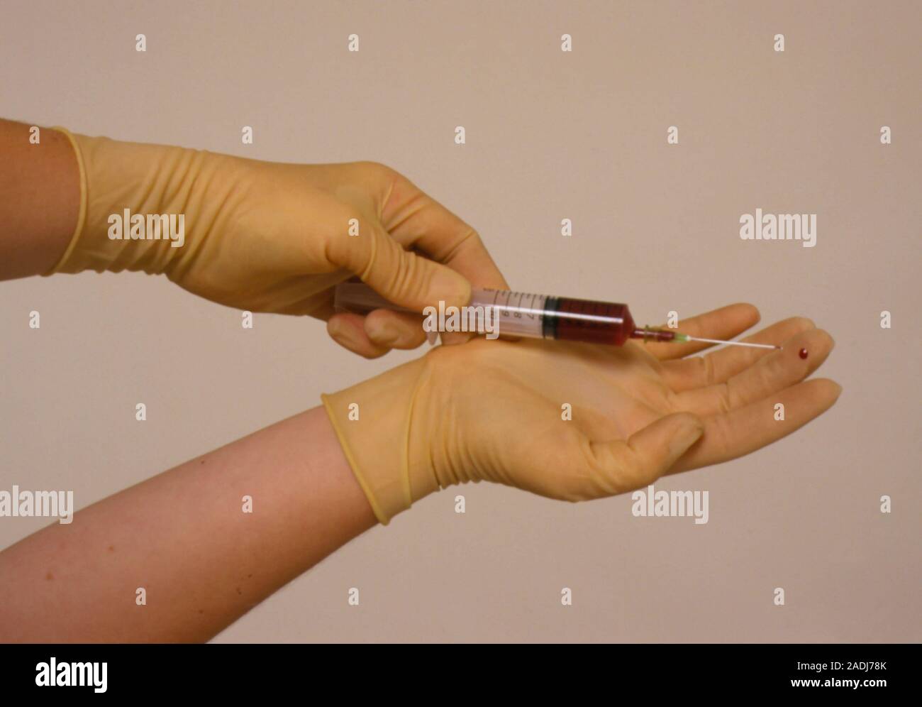 La toma de muestras de sangre de la infección. Mano enguantada en el dedo por la aguja de una jeringa usada para tomar una muestra de sangre venosa. A menos