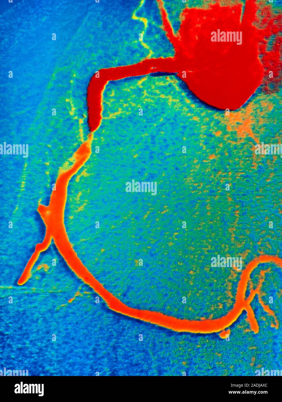 Angioplastia El Angiograma Color Tomadas Durante Una Angioplastia Angioplastia El Angiograma Color Tomadas Durante Una Angioplastia