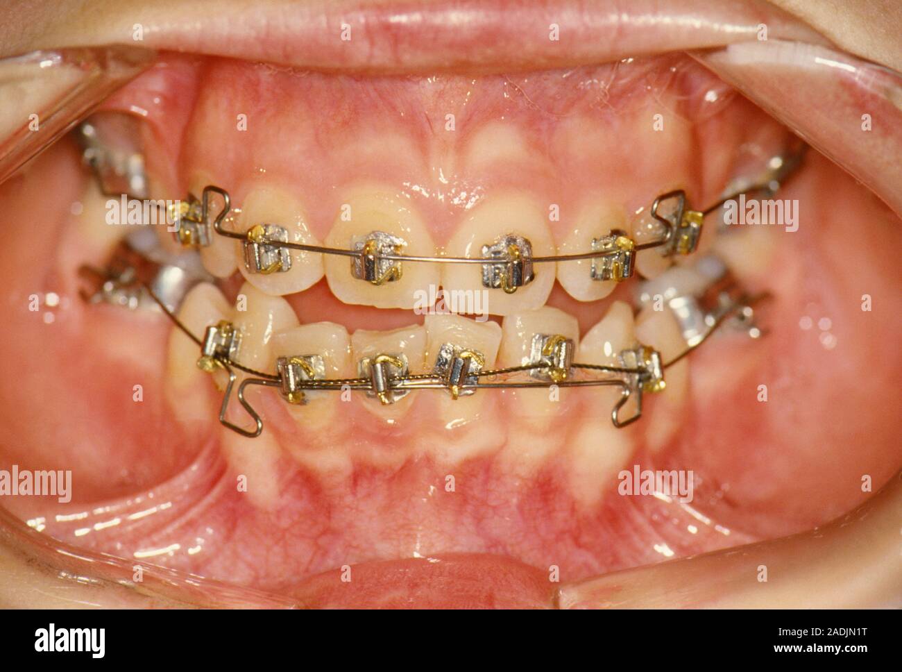 Abrazaderas dentales. Close-up de frenos ortodónticos fijos a los dientes  de un paciente. La boca se mantiene abierta con retractores dental. Los  dientes incisivos inferiores son p Fotografía de stock - Alamy