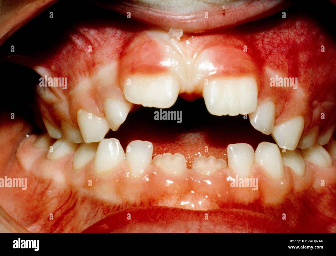 Cerca de la boca de una persona que muestre los efectos deformative de  chuparse el dedo sobre los dientes y las encías. Los 2 incisivos superiores  (centro) son particularmente aff Fotografía de