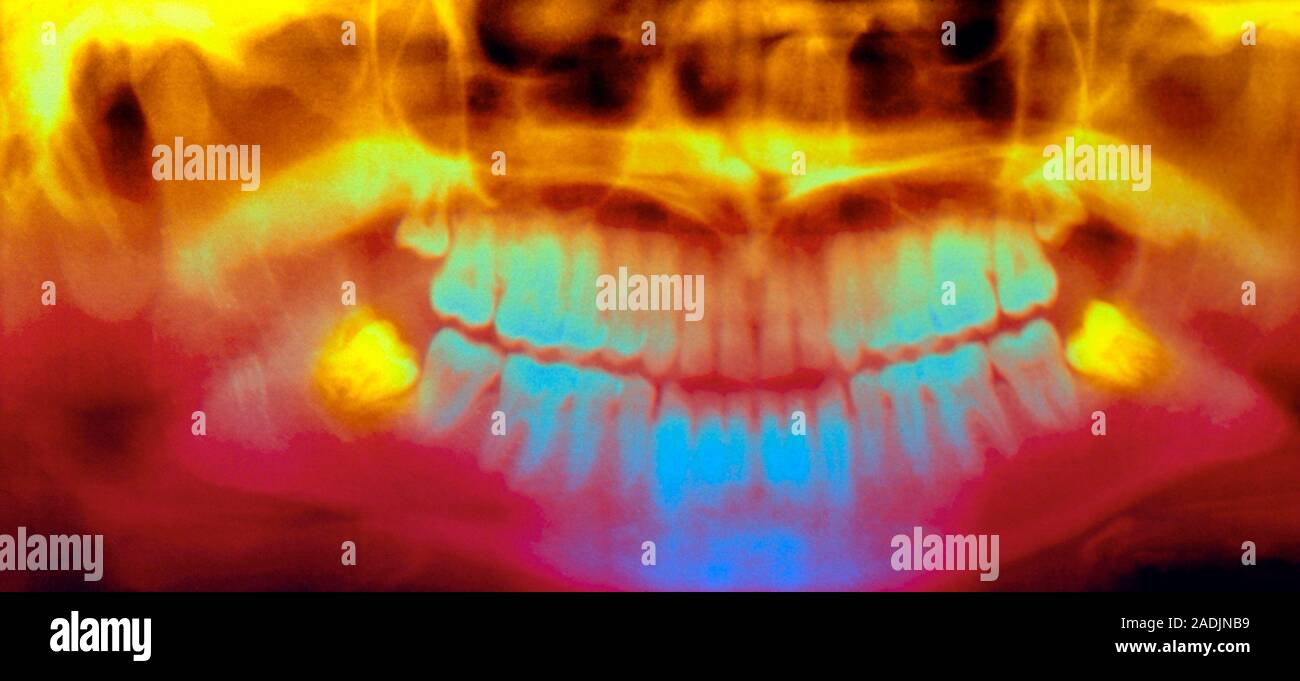 Las muelas del juicio impactadas. Pan de color-oral de rayos X de la