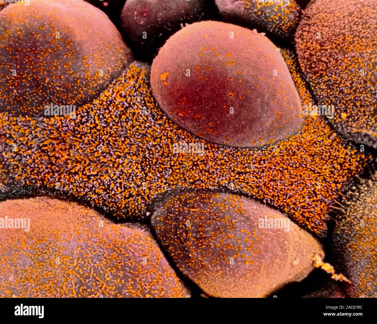 Hobnail adenocarcinoma de ovario. Color análisis micrografía de electrones  (SEM) de células claras adeno-carcinoma de células de cáncer de ovario  humano. Conoce als Fotografía de stock - Alamy
