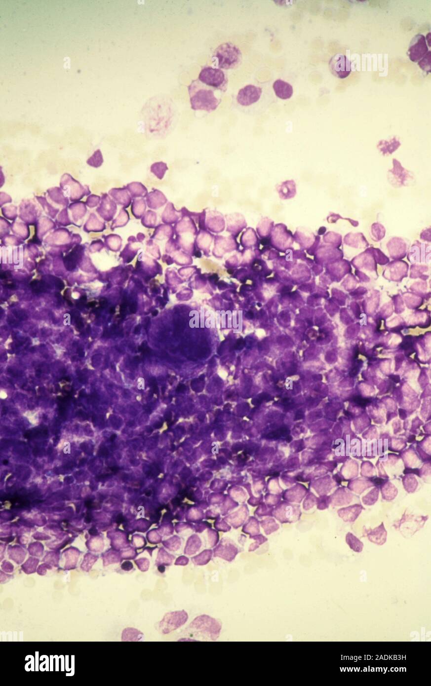 Micrografía de luz de médula ósea humana que llena los espacios ...