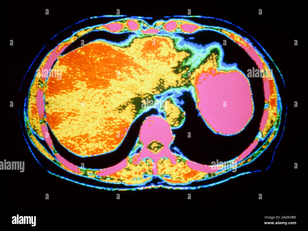 El Hígado Y El Estómago Coloreado De Tomografía Computarizada Ct De La Sección Transversal 3210