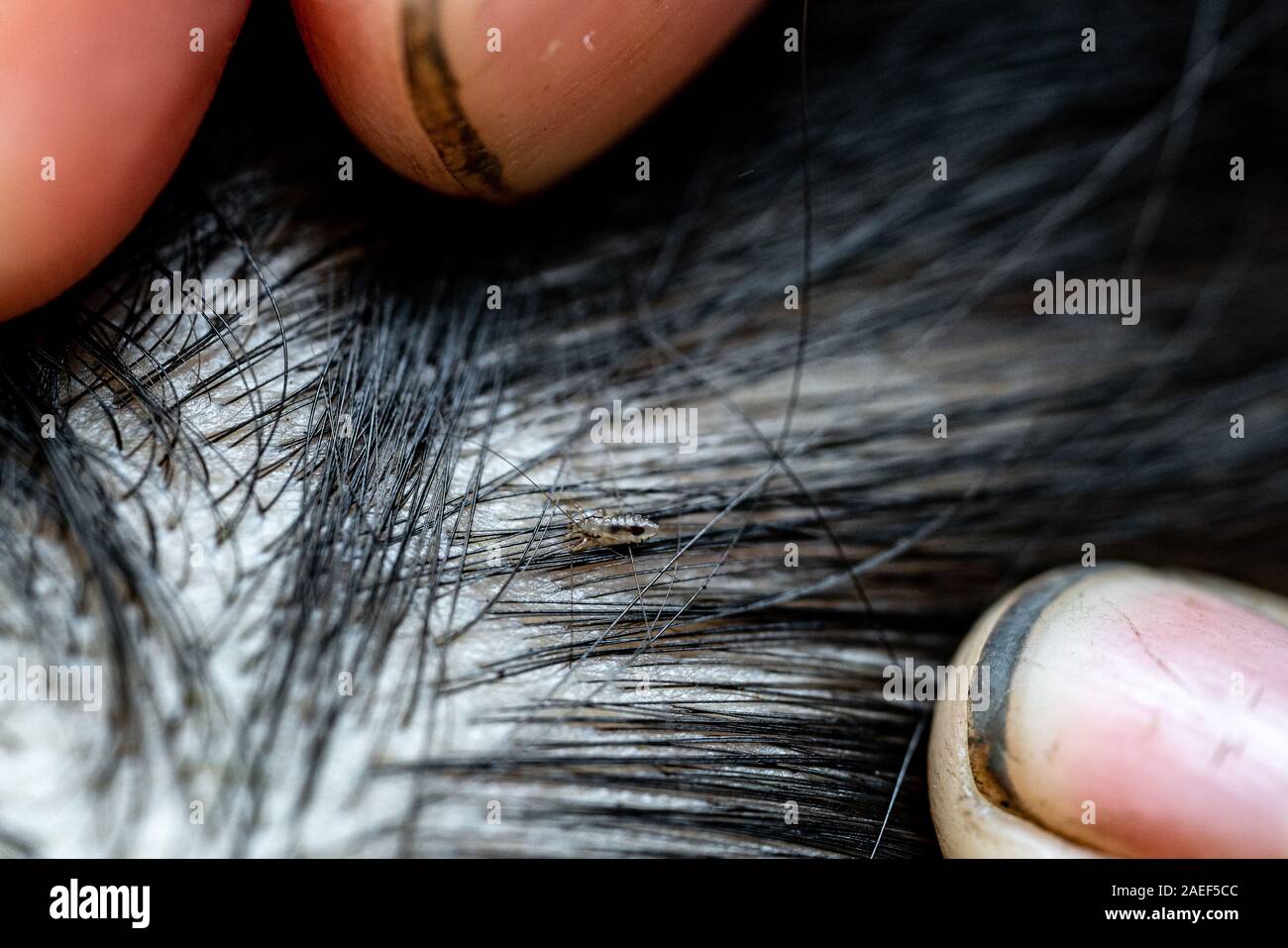 Huevos de piojos en el cabello provoca picazón en la cabeza Fotografía de  stock - Alamy