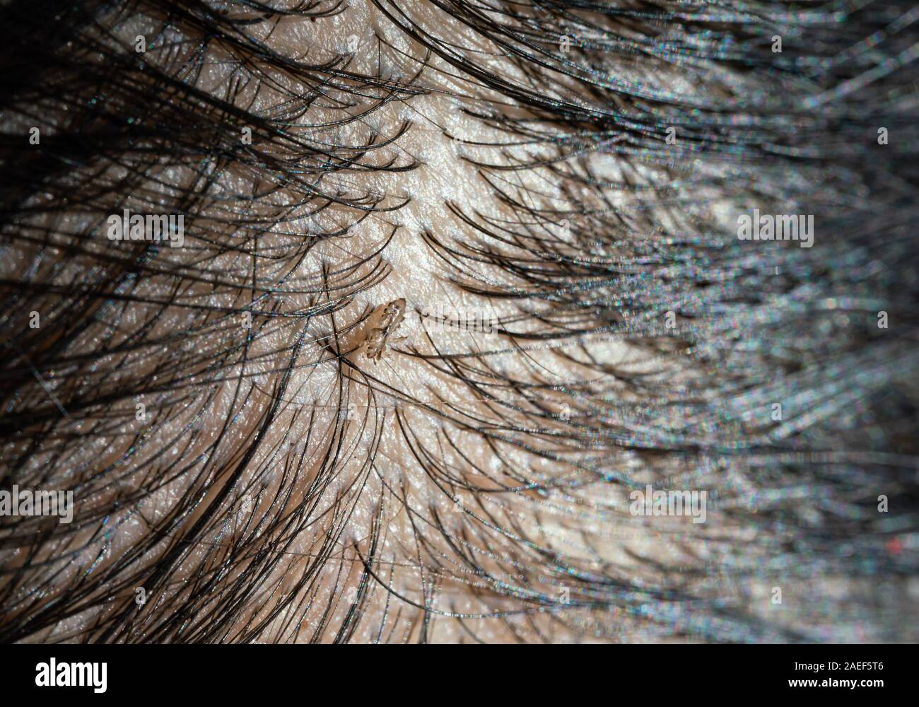 Huevos de piojos en el cabello provoca picazón en la cabeza Fotografía de  stock - Alamy