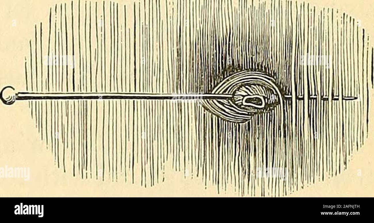. Los principios y la práctica de la cirugía. ss durante el sexto método, ideado por el Sr. Keith, de Aberdeen, y el séptimo, sugerido por Mr.Pirrie, y sólo brevemente aluden al método theeighth, sugerido por el Dr.Buck, de Nueva York, y el noveno, sugerido por el Dr. Hutchison, ofBrooklyn. En la operación por el octavo método, el primer paso consiste en seizingthe boca del vaso sangrante entre las aspas de un par de thumbforceps, y rotación de la extremidad de la arteria por lo menos dos veces en itsown eje. El segundo paso requiere que la aguja debe ahora bethrust completamente a través de la arteria retorcida, cerca Foto de stock