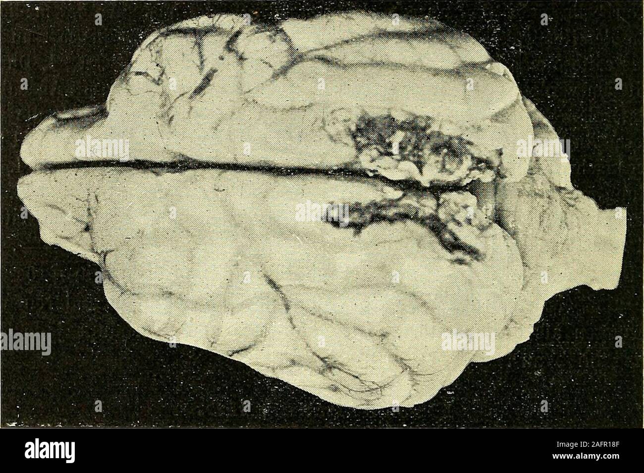 . Physiologische und klinische Untersuchungen über das Gehirn, gesammelte Abhandlungen. (Zu Beob. 120.) Rand hintere liegt am Ansatz des Tentoriums. Es liegt die I. Urwindungfrei. I. Urwindung Umschneidung der auf 1 cm tief mit dem Messer, Heraus-hebung der umschnittenen Partie mit dem Präparatenheber gegen hoz undTentorium. Die Wundheilung erfuhr insofern eine Störung, als die beim Vernähen   440 - ümgeldappten Wundränder am 7. Tage angefrischt werden, mussten woraufdie Wunde Verbände unter aseptischem ohne Eiterung bis zum 25. Tage lang-sam zugranulirte. Motilitätsstörungen fehlen. Sehstöru Foto de stock