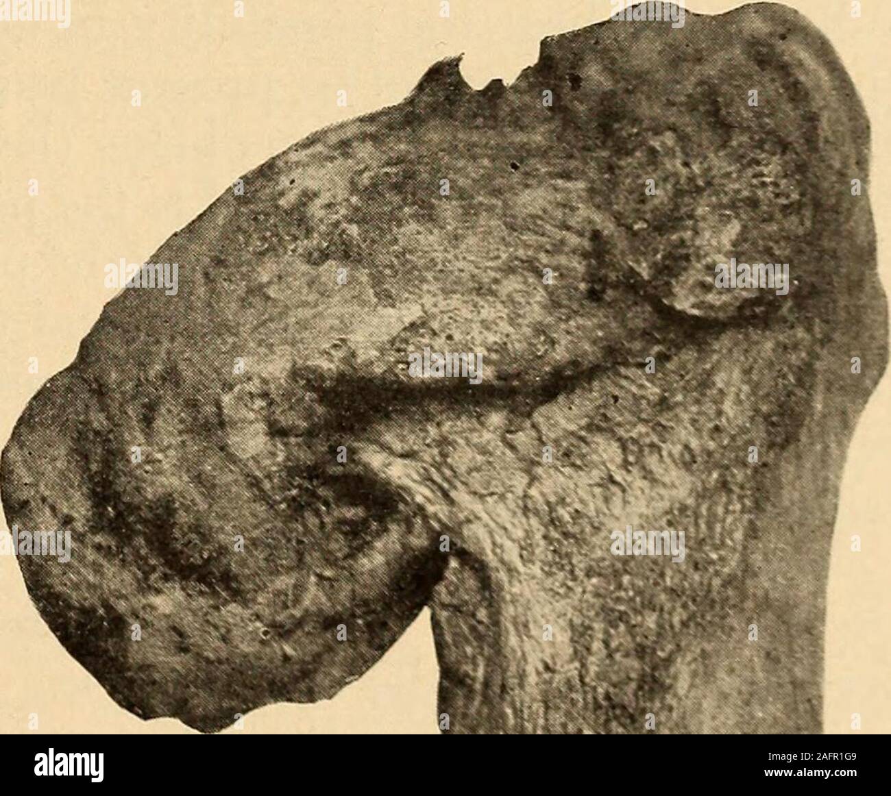 Un tratado práctico sobre fracturas y dislocaciones. La fractura del cuello  ; sanado. (U. S. Ejército Med. Museo.) lo suficiente del periostio del  cuello para hacer una vigorosa vitalidad de cabeza
