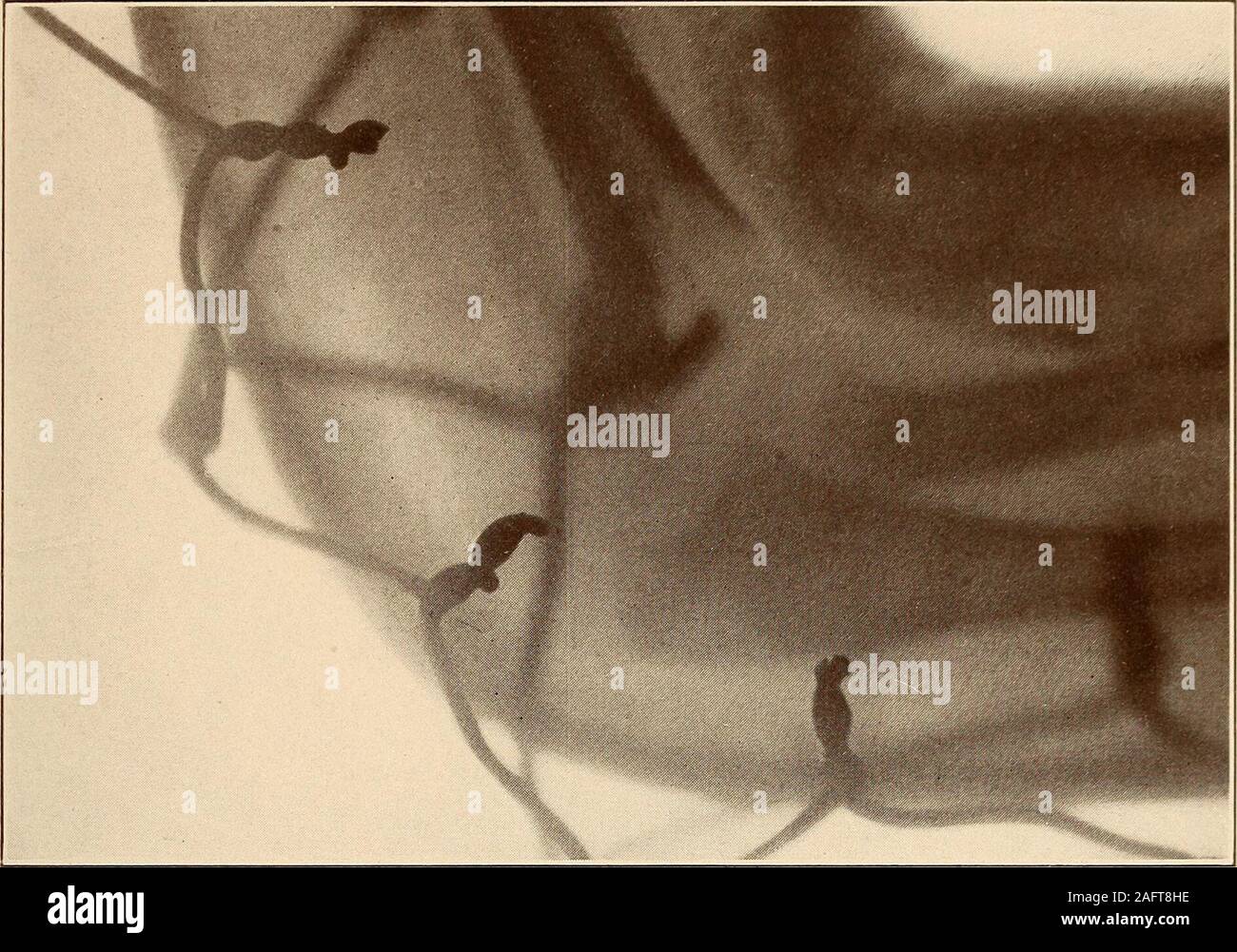 . Un tratado práctico sobre fracturas y dislocaciones. Placa n IX. Fig