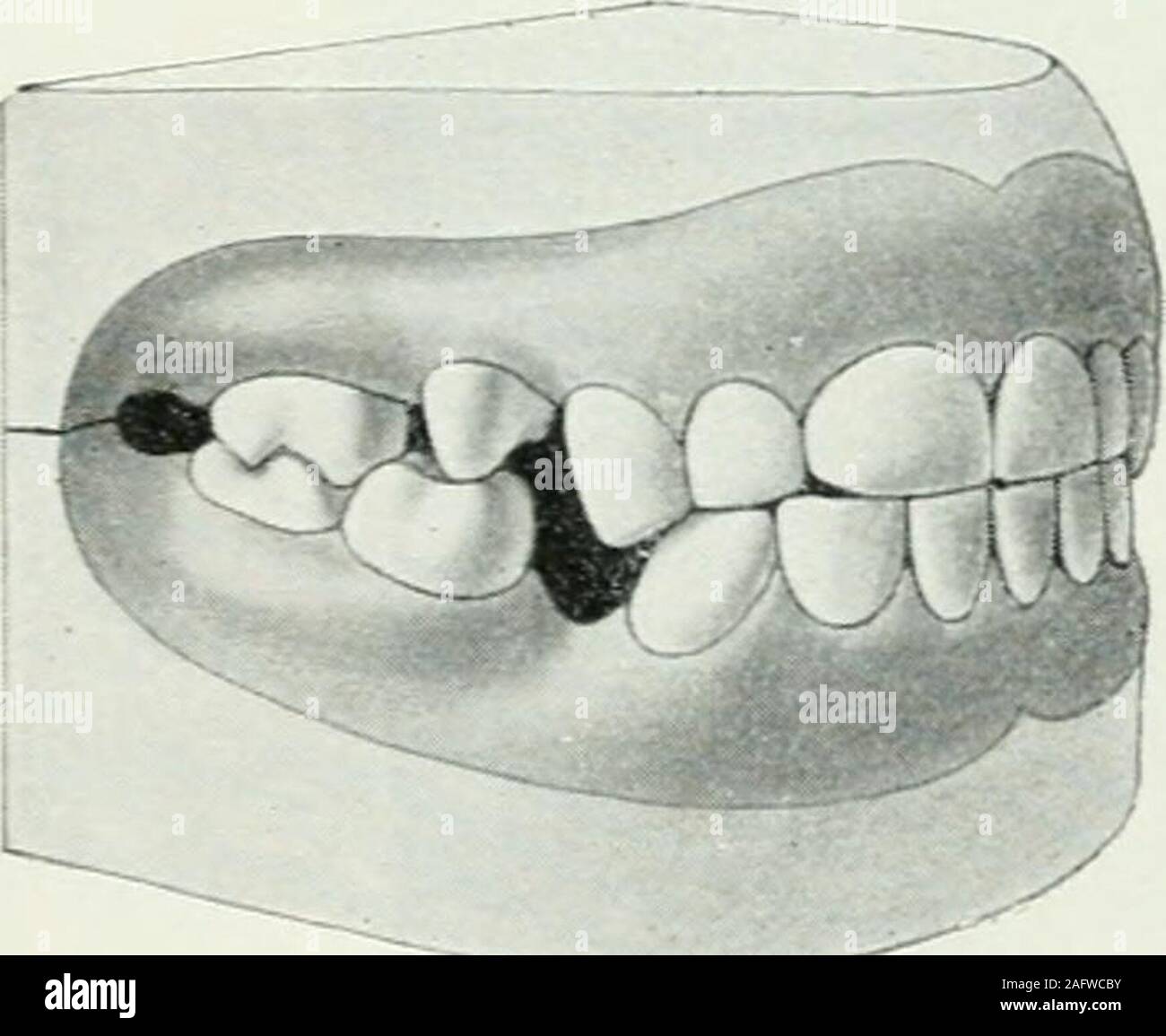 . Lehrbuch der orthodontie fur und studierende enschluss zahnartze mit der Geschichte der orthodontie. Fig. 51 veranschaulicht den unten partiell vorstehenden Biß. Der unten vorstehende Biß total (Fig. 52)-charakteri ist sehr großen siert durch den Oberkiefer Unterkiefer,der weit überragt,und durch anormale Artikulationaller Zähne. Die äußeren Höckerder oberen Prämolarenartikulieren Molaren und mit den inneren Hök-kern.Auch der Unteren gleichnamigen beißen alle unteren Zähne umetwa drei Viertel Molarenbreite zuFl§- 53- ) weit nach vorne. Der Aufbiß (Fig. 53), daßdie gekennzeichnet dadurch ist Foto de stock