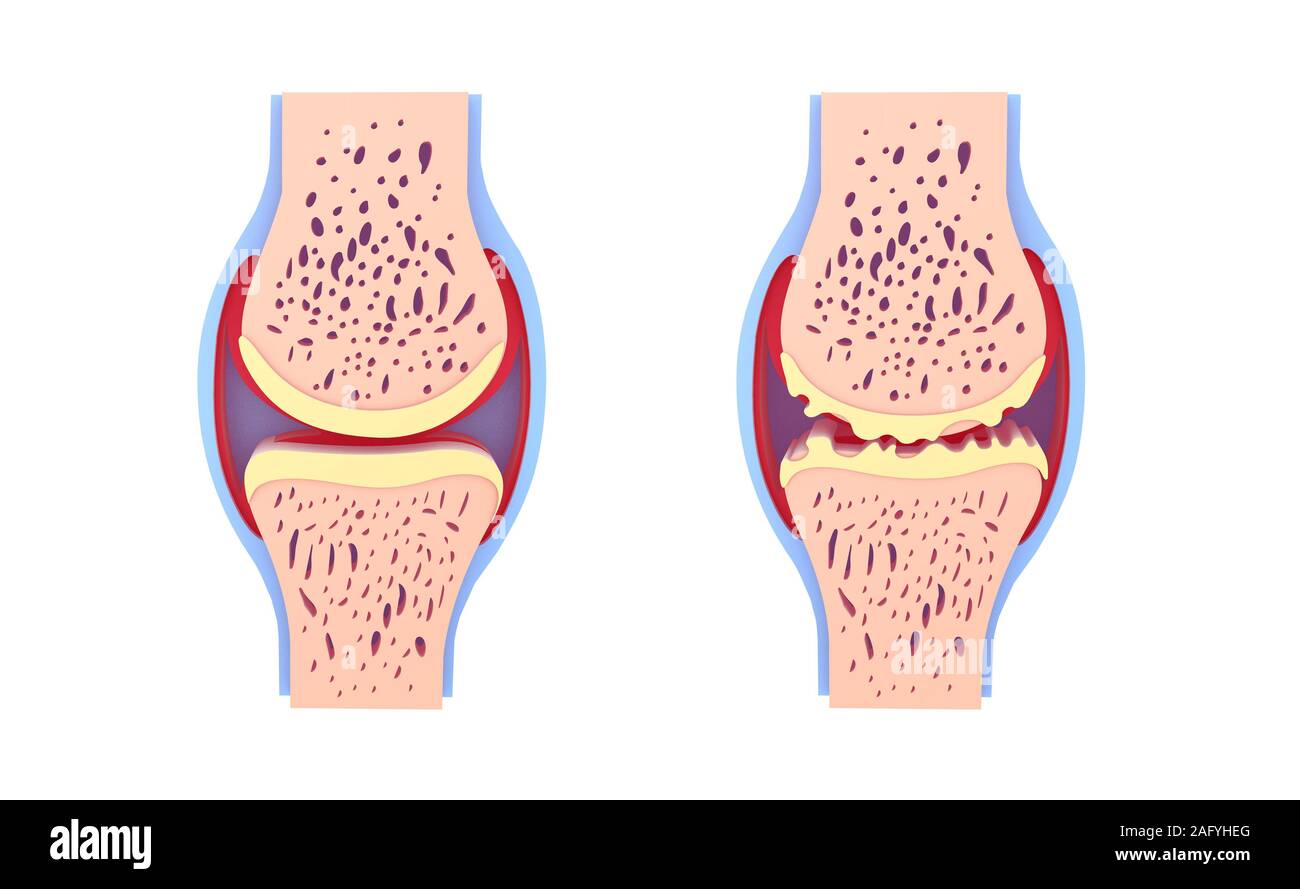 Ilustración 3d de sinovial sano y conjunta con osteoartritis. Imágenes aisladas sobre fondo blanco vista delantera. Colores vivos. Foto de stock