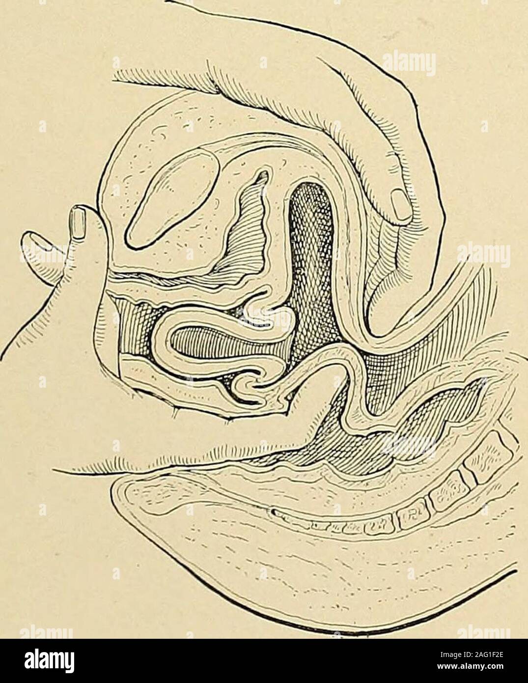 El diagnóstico y tratamiento de enfermedades de la mujer. Fig. 270.  Carcinoma]de Labium Minus, comienzo. (Hirst, enfermedades ofWomen.)  CARCINOMA DE LABIUM 205. Fig. 271. Carcinoma de Labium en un escenario  mayor.(Hirst