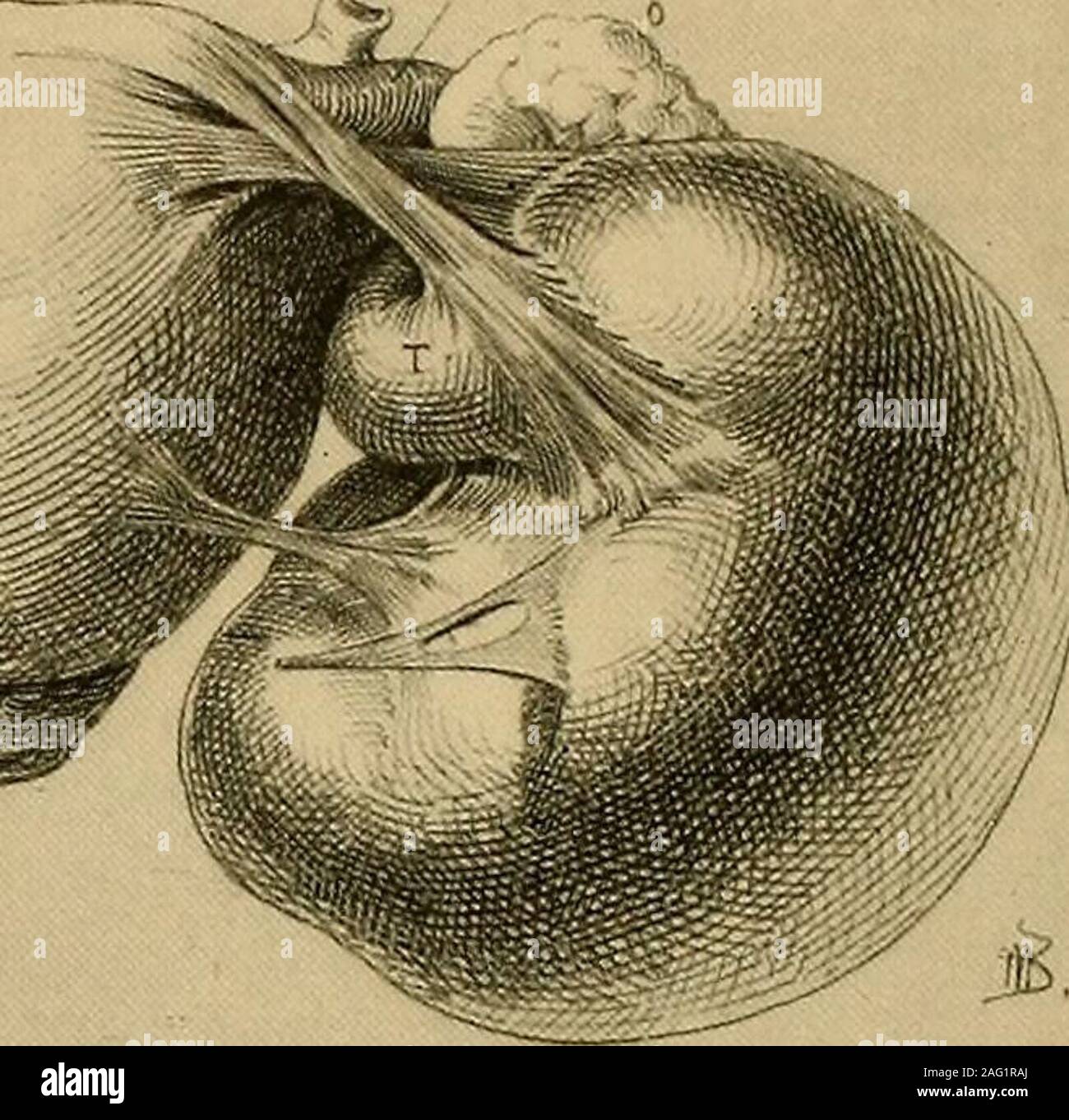 Ooforectomia, Miomectomia es - OOFORECTOMIA. Es un procedimiento