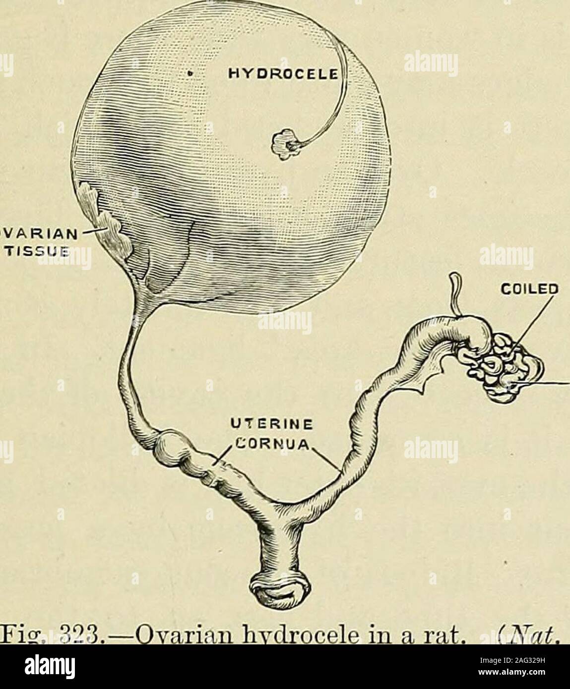 tratamiento de hidrocele