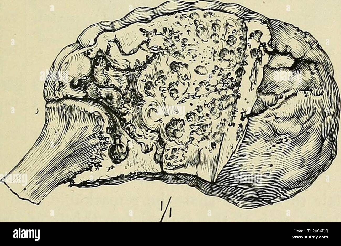 Tumores malignos y inocentes; sus caracteres clínicos y el tratamiento  apropiado. Fig. 31.-El mieloma de la EUD inferior del radio. (Maseuij/, St.  ThomasesHospital.) de las mordazas excisión parcial ha sido realizada