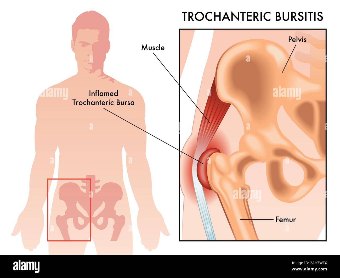 Ilustración médica mostrando trochanteric bursa o trochanteric bursitis en la cadera humana masculina de diagrama. Foto de stock