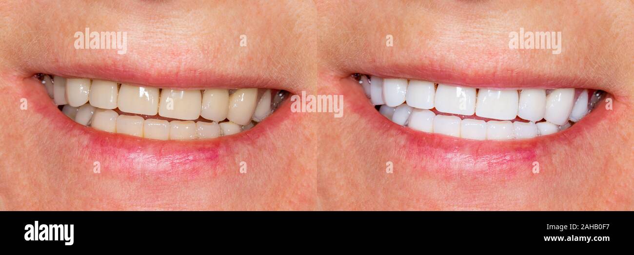 Carillas dentales, coronas de cerámica antes y después del tratamiento