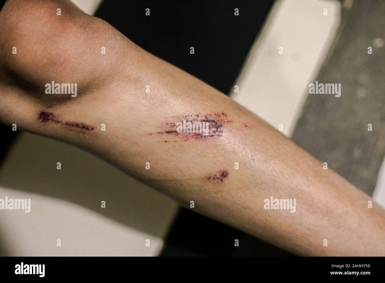 Muchas lesiones accidente de rascarse la pierna de la mujer Foto de stock