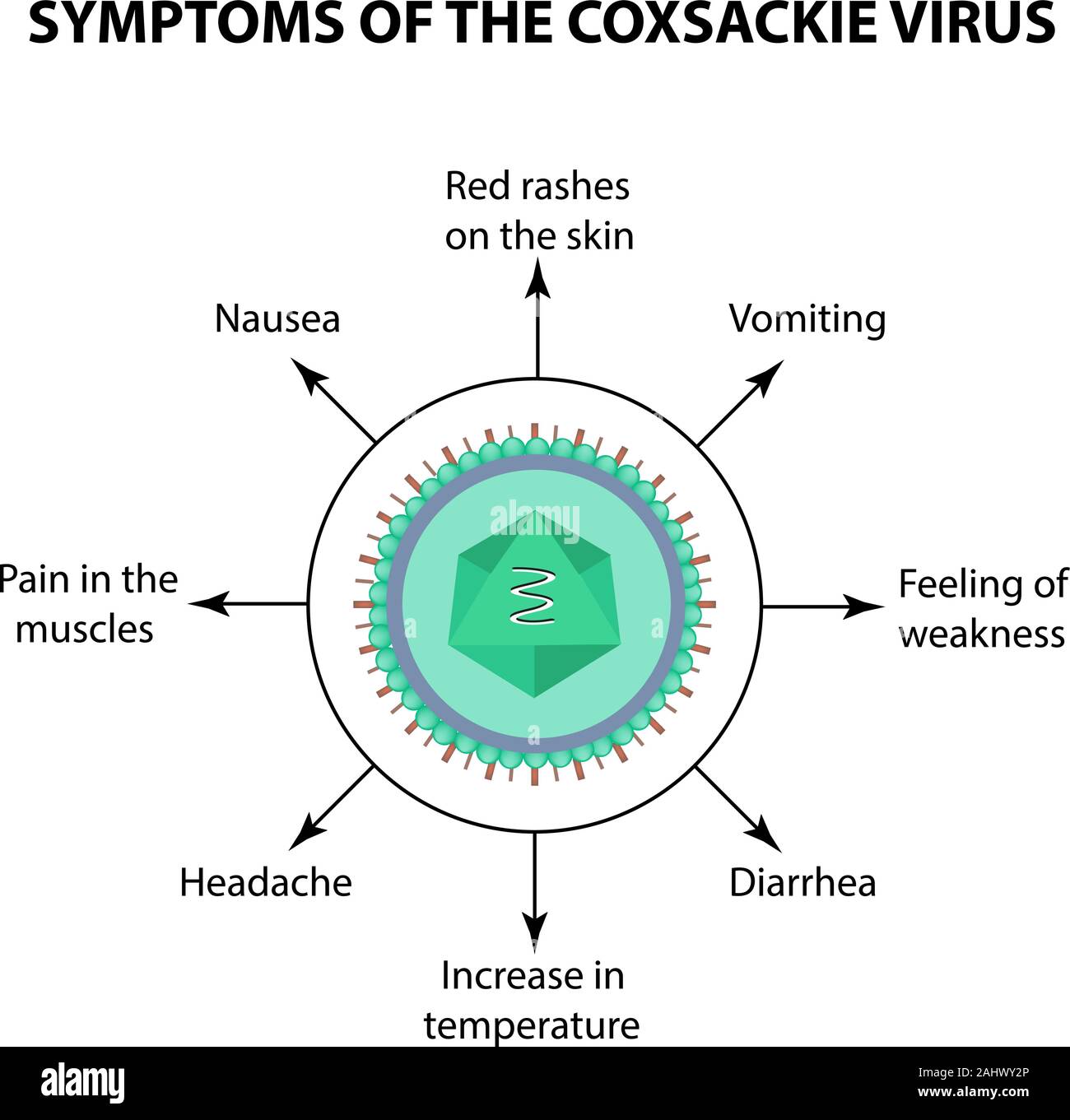 Los síntomas de la infección de virus Coxsackie. Enterovirus. La
