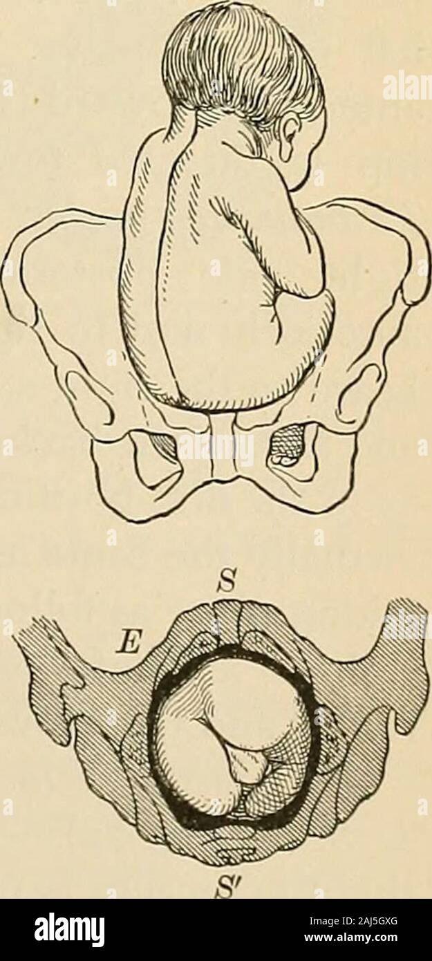 Un manual de obstetricia . Un segundo esfuerzo leve a la restitución