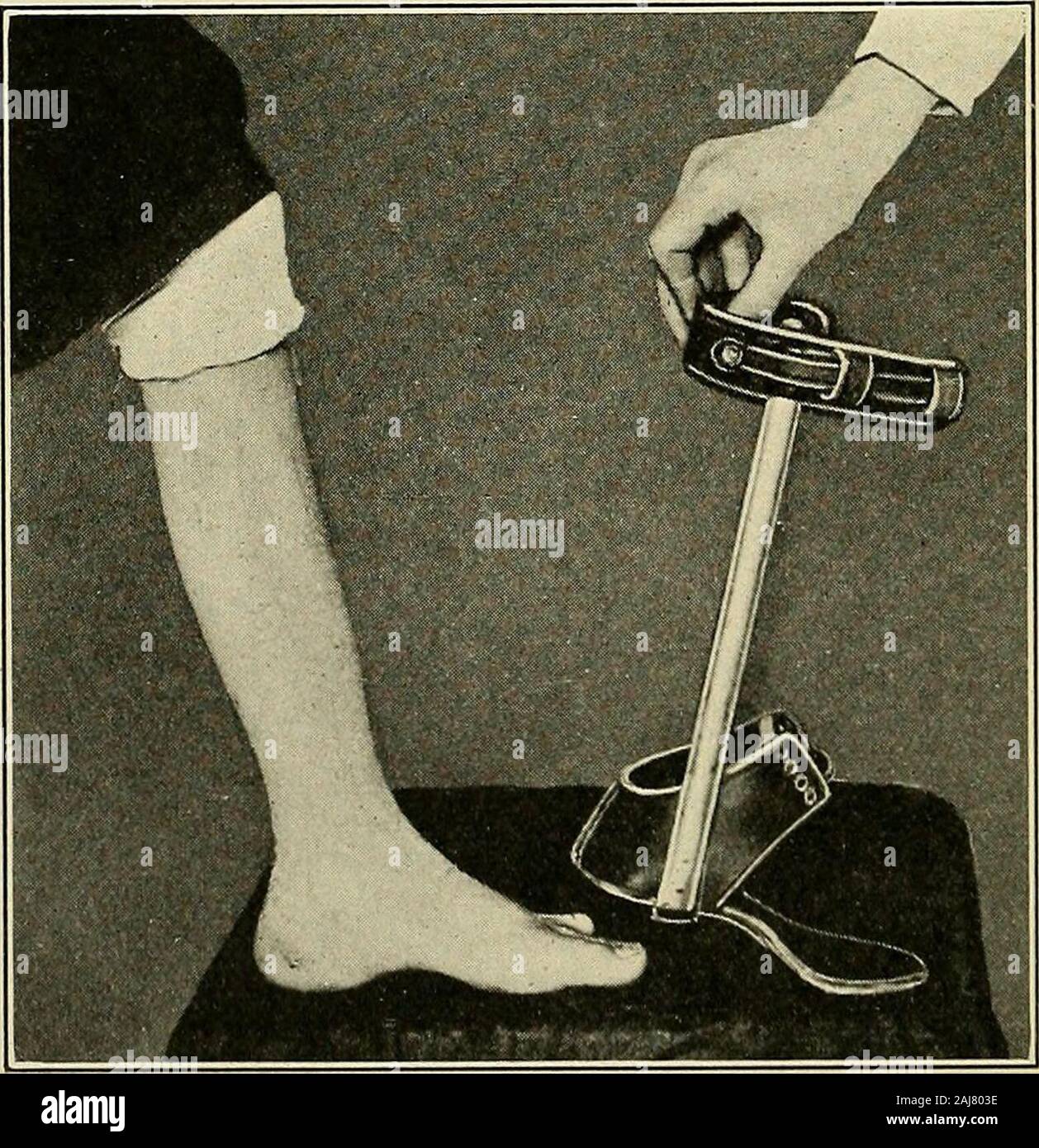 Talipes Calcaneovalgus Fotos e Imágenes de stock Alamy