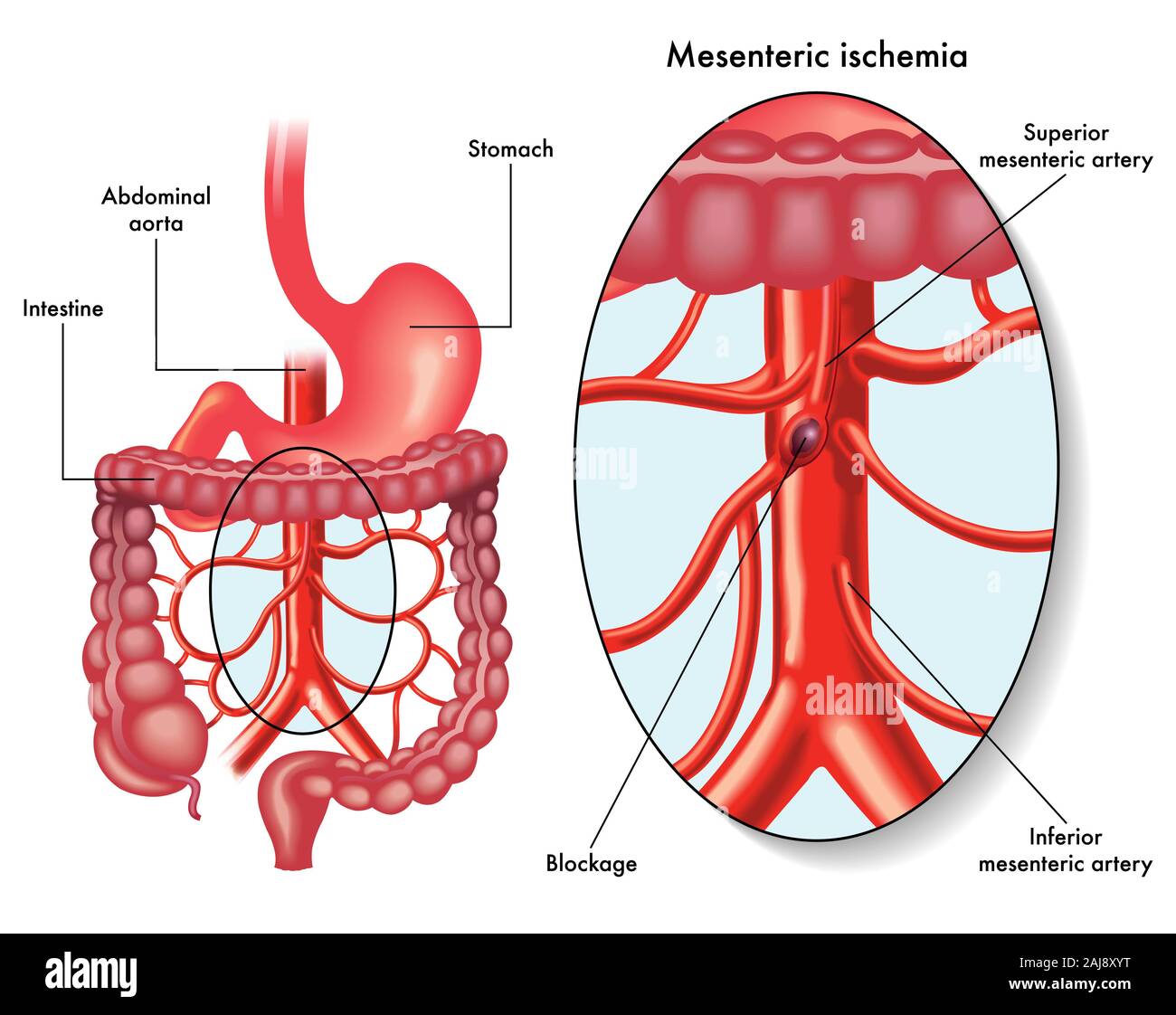 Ilustración mostrando una isquemia mesentérica también llamado infarto intestinal, una obstrucción de la circulación sanguínea, afectando la arteria mesentérica Foto de stock