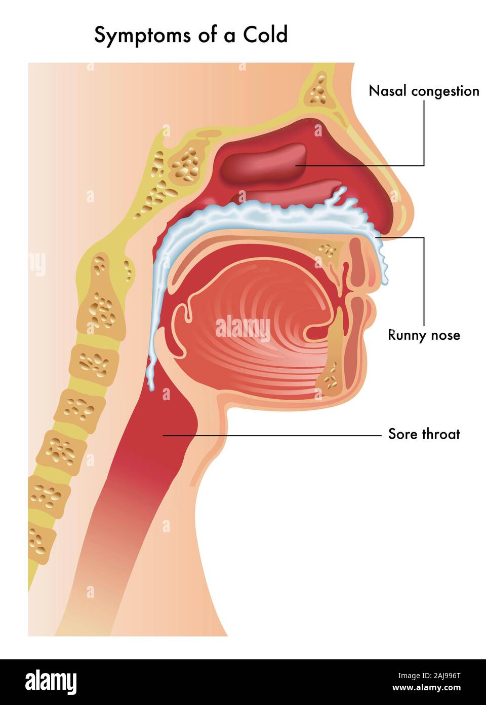 Una ilustración médica de la parte superior del tracto respiratorio de una persona con los síntomas de un resfriado común. Foto de stock