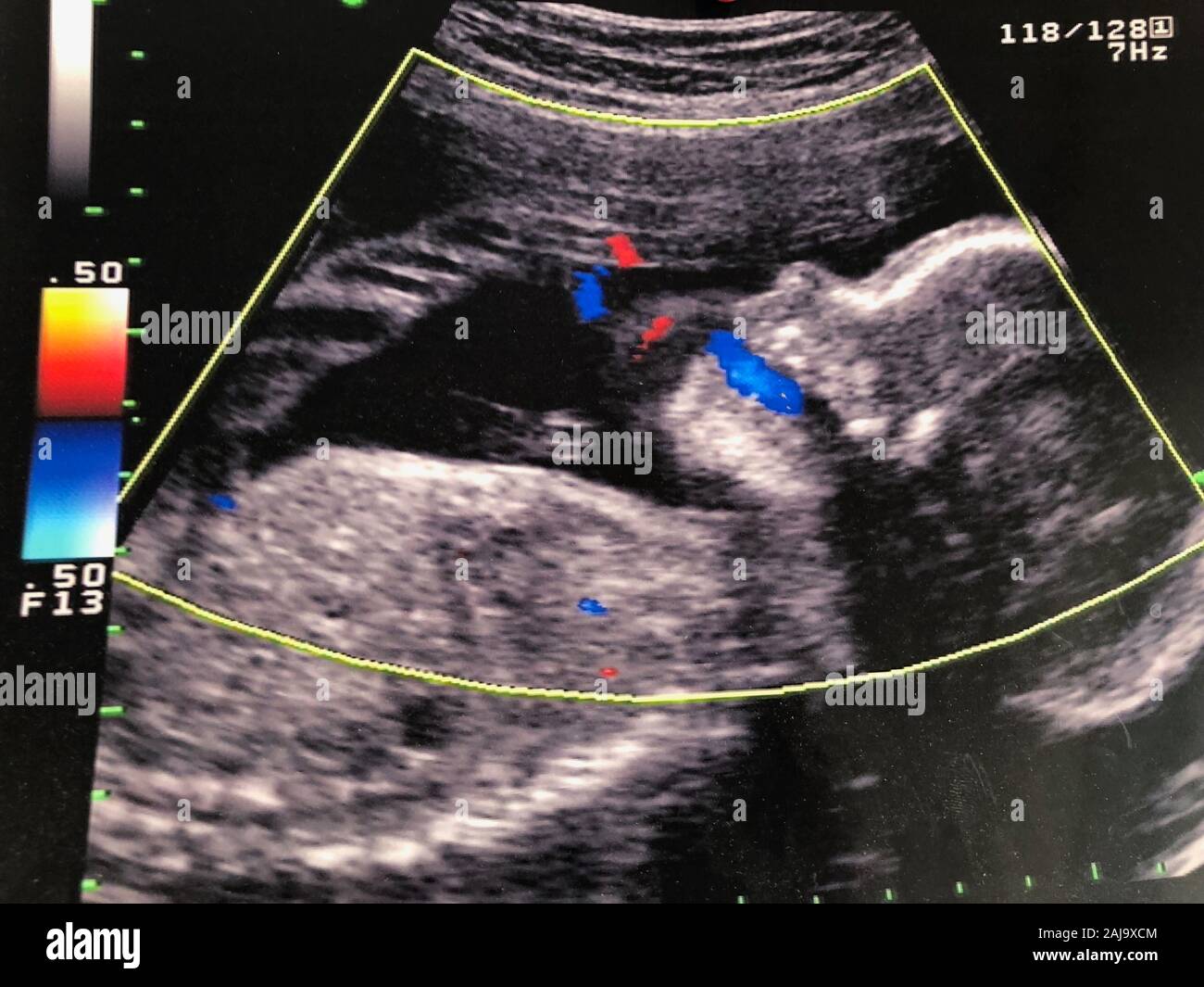 Líquido amniótico fotografías e imágenes de alta resolución Alamy