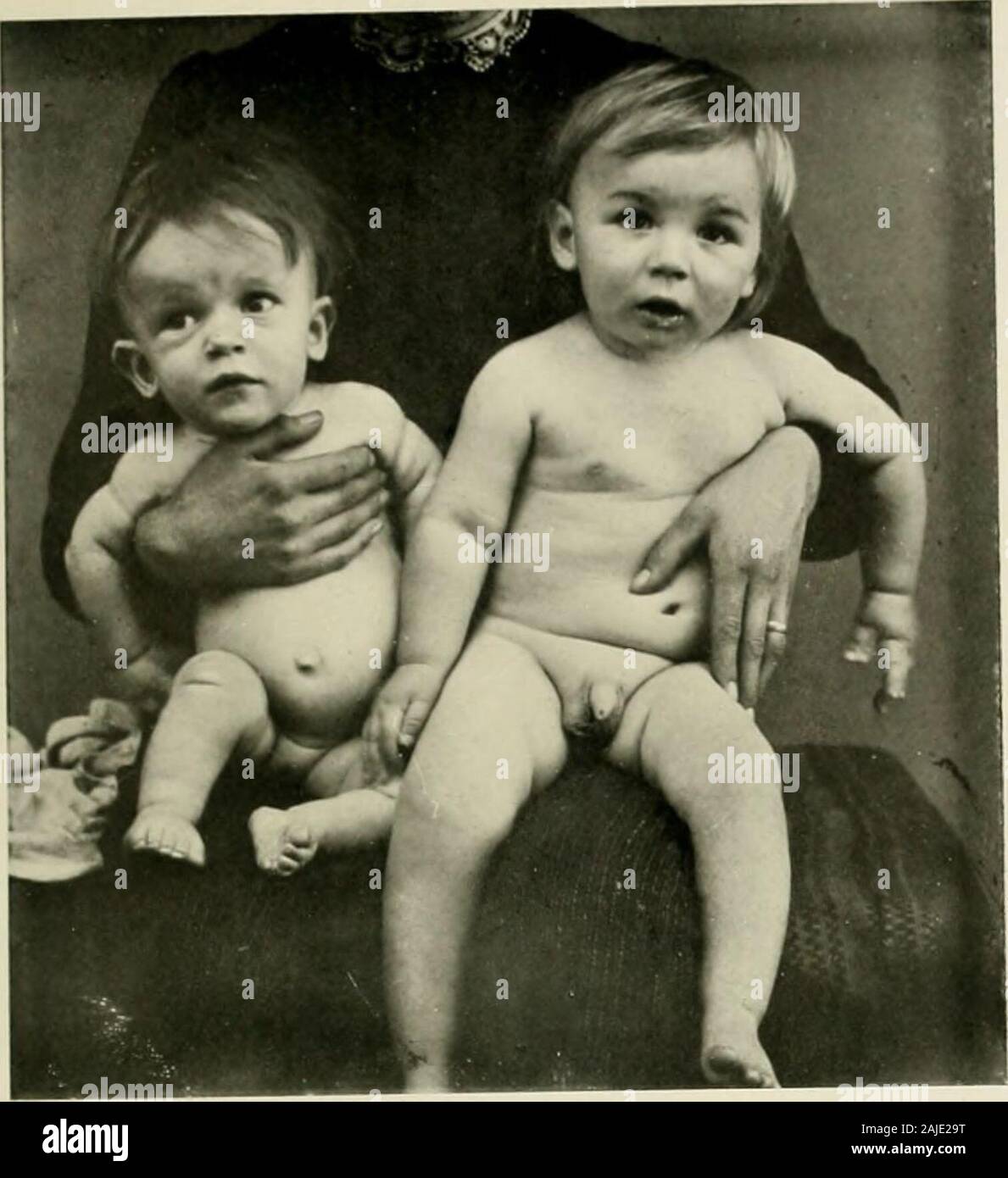 Achondroplasia Fotos E Imagenes De Stock Alamy