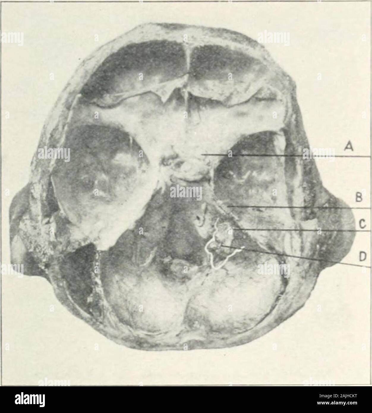 Transacciones . cubiertos con fibrinopurulent exudado. Los senos venosos son gratuitos. Oftympanum Eoef está intacto; no hay evidencia de extensión dela ])urulet)f intiammafion thi-ough el hueso petrous o thedura. La proyección del th(^ ])osterior sui-cara del petrous boneis una masa tumoral nodular. IHV, IU. m. por 19i/&GT; m. m. I)rojects Thetumor &LT;s ui. m. Más allá de th(^ tabla interna, sustituir el hueso y la duramadre en este punto. En el margen superior del tumor se extiende sobre el meato auditivo interno, butdoes no llegar a la tienda. La superficie de tlietumor iiodular es suave y está enrojecido y va Foto de stock